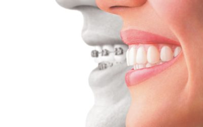 What’s the Difference between Braces, Functional Appliances and Retainers?